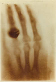 Raggi X, la prima radiografia